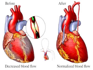 Congestive Heart Failure