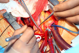 Top Cardiac surgeon in India