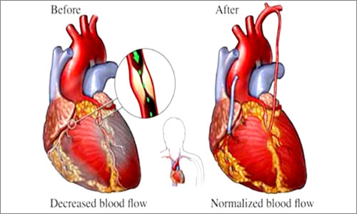 Successful Coronary Artery Bypass Surgery in Extremely poor heart function