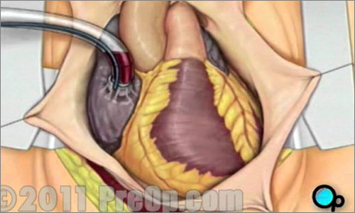 Complex Coronary Bypass Surgery