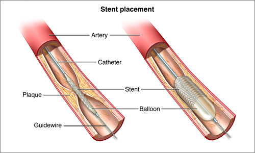 ASD heart surgery in Adult female