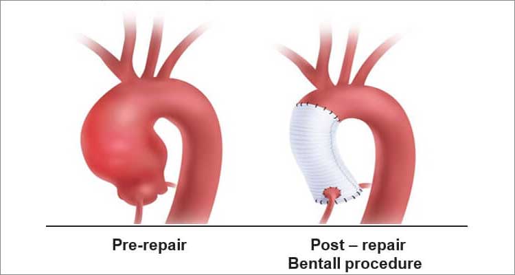 Aortic root surgery