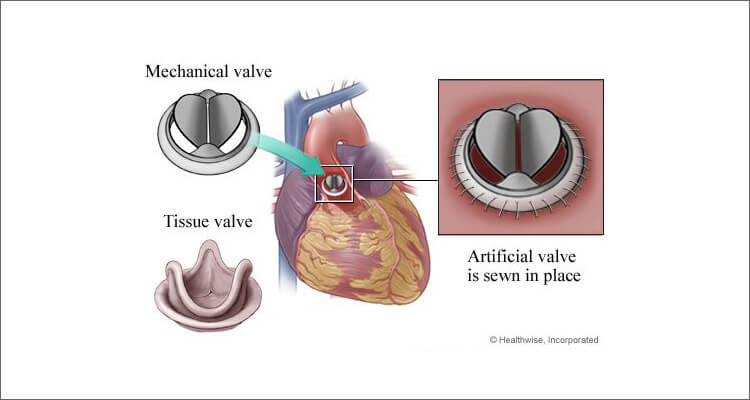 Aortic Valve Replacement Diagram