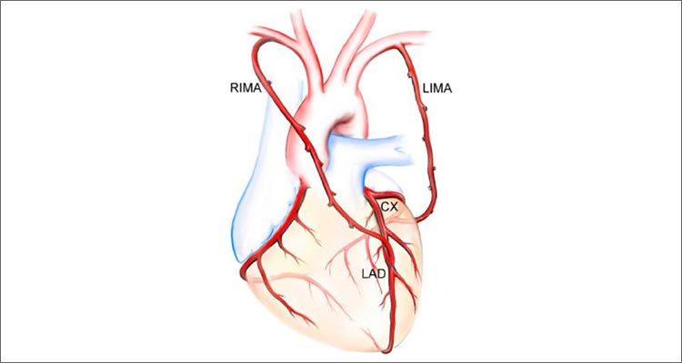 Arterial Type Coronary Bypass Surgery Diagram