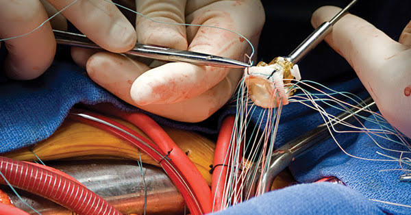 Arterial type coronary artery bypass surgery
