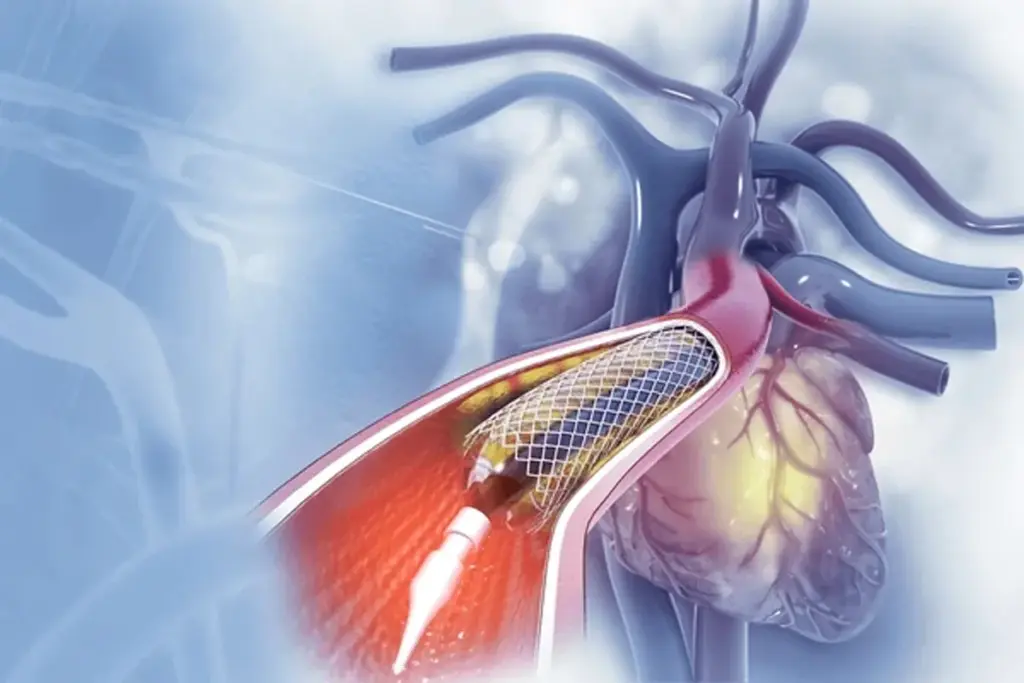 Arterial type coronary artery bypass surgery